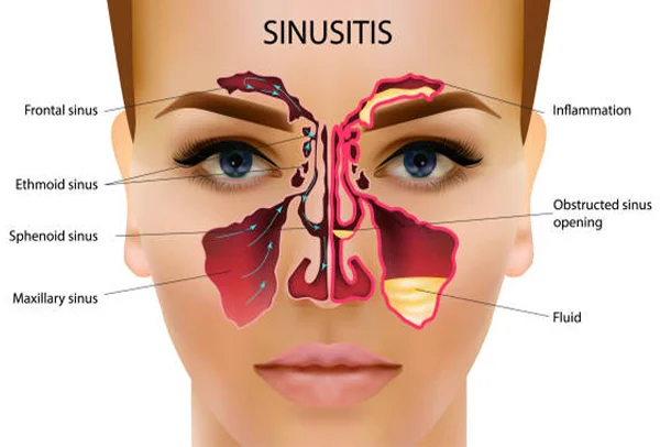 Sinusitis
