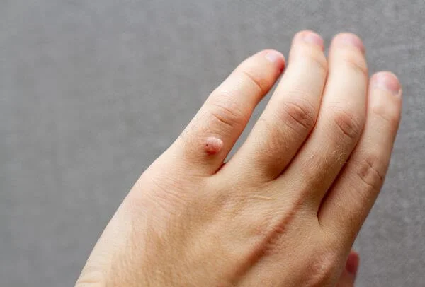 Warts