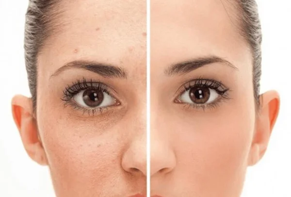 Pigmentation