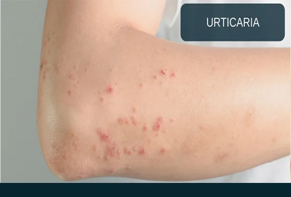 Urticaria