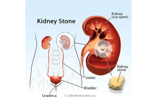 Renal Stones