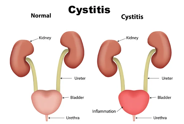 Cystitis