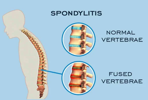 Spondylitis