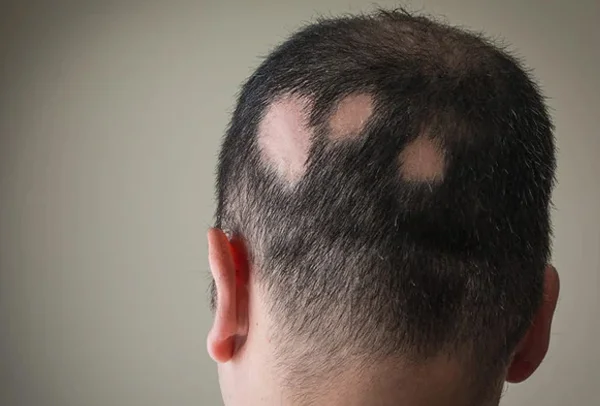 Hair Disease