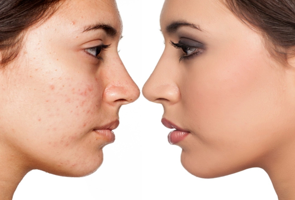 HOMEOPATHIC TREATMENT FOR ACNE