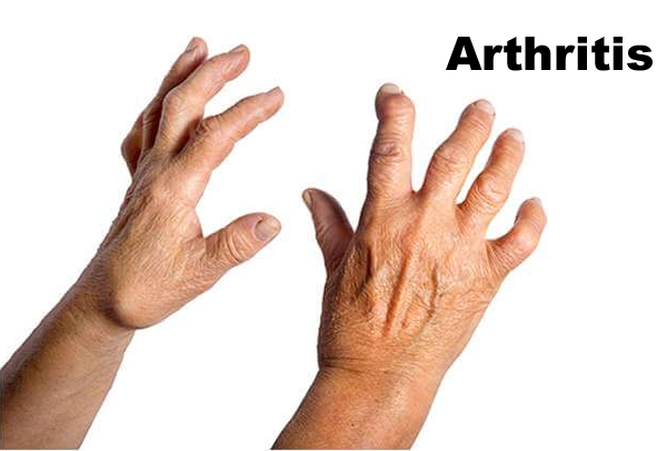 Natural Treatment For rheumatoid arthritis