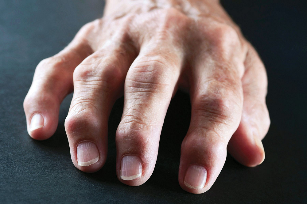 HOMEOPATHIC TREATMENT FOR RHEUMATOID ARTHRITIS