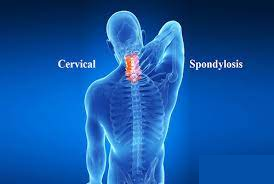 Homeopathic doctor for cervical spondylitis