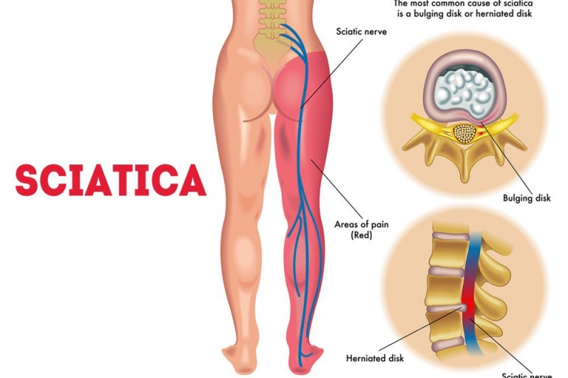 homeopathy treatment for  sciatica