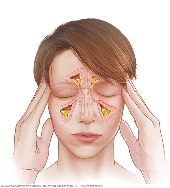 Natural Treatment For Migraine