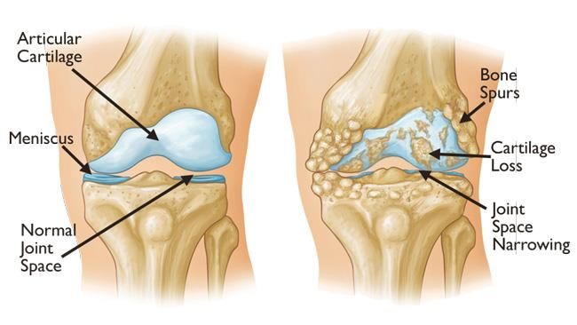 Best Natural treatment for osteoarthritis