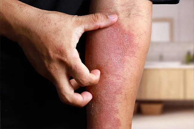 HOMEOPATHIC TREATMENT FOR DERMATITIS