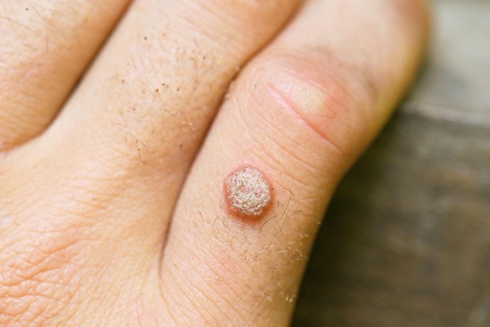 HOMEOPATHIC TREATMENT FOR WARTS